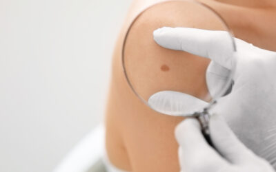 Why Mole Checks are More Important Than Ever in the UK