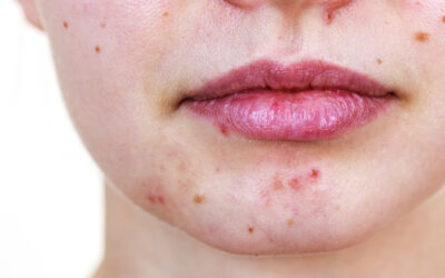 Acne Treatments in 2025 – What Really Works?